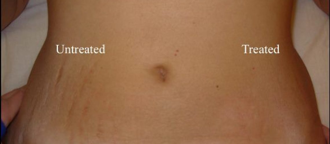 Home-Remedies-to-Get-Rid-of-Stretch-Marks-Removal
