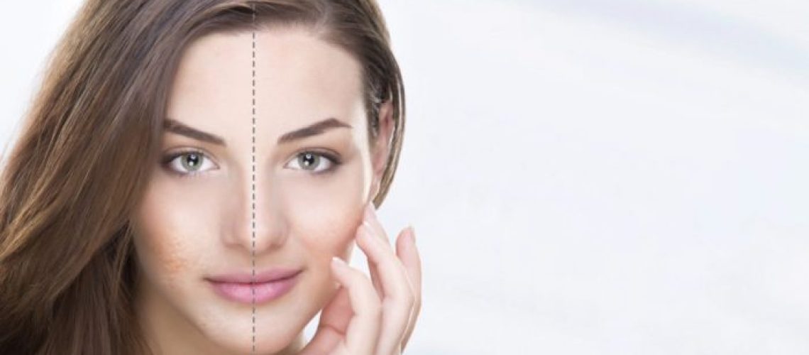 acne-model-split-face-your-patients-dont-have-700x349