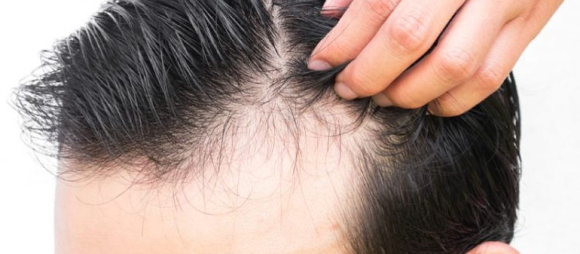 male-pattern-hair-loss-750x430